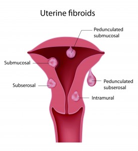 fibroids